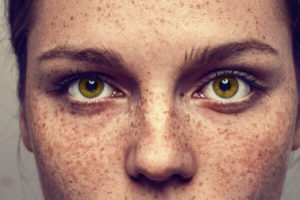 Face Analysis Technology Freckles